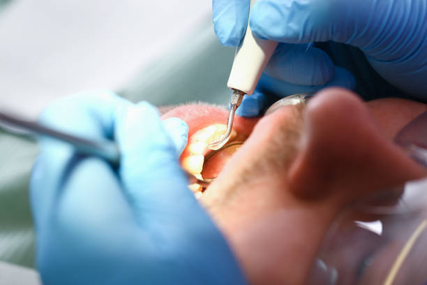 Best Emergency Dentist for Lost Fillings or Crowns in Kenneth City, FL